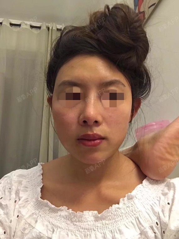 图一和图二2017年找陈小伟做的鼻子鼻孔一大一小人中和鼻子都对不住还