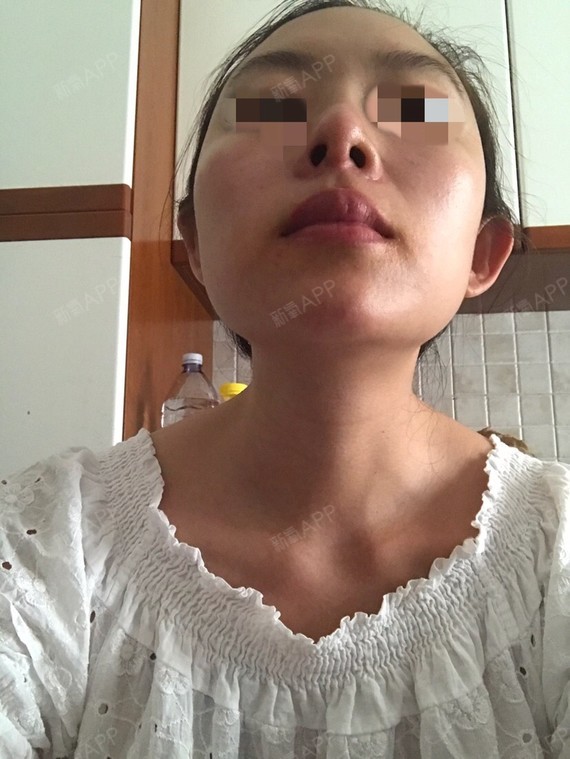 鼻孔一大一小.鼻翼两_圈子-新氧美容整形