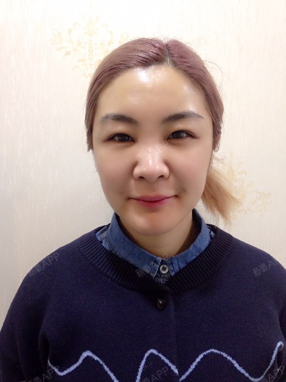 术前面部容量流失导致皮肤松弛下垂,鼻唇沟,嘴角纹明显,面部两侧略凹.