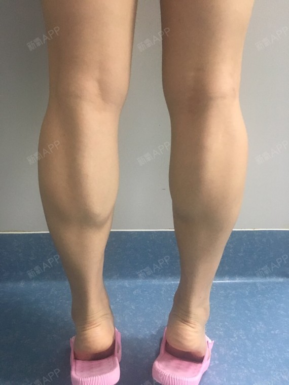 肌肉脂肪混合型小腿图片