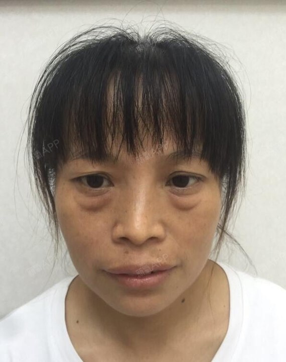 哎,平时亲戚都说我眼睛没精神,说我眼袋大显老之前还_圈子-新氧美容整