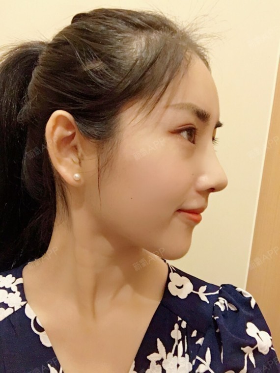 南京耳软骨复合隆鼻好不好_效果图_匠酱耳软骨复合隆鼻术后第7天_新氧
