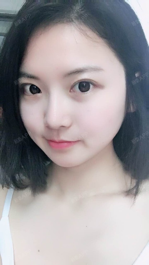 下颌角整形好不好_效果图_爝下颌角整形术后第336天_新氧美容整形