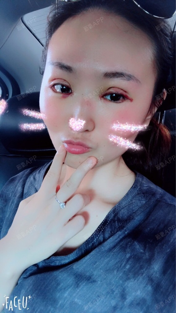 切开双眼皮