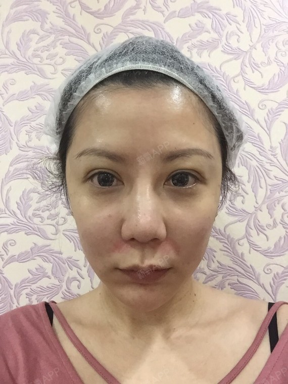 拉皮手术提升好不好_效果图_潘妮儿拉皮手术提升术后第17天_新氧美容