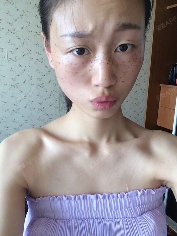 满脸麻子的自己又来了,感觉没有太大的变化,感觉脸太_圈子-新氧美容