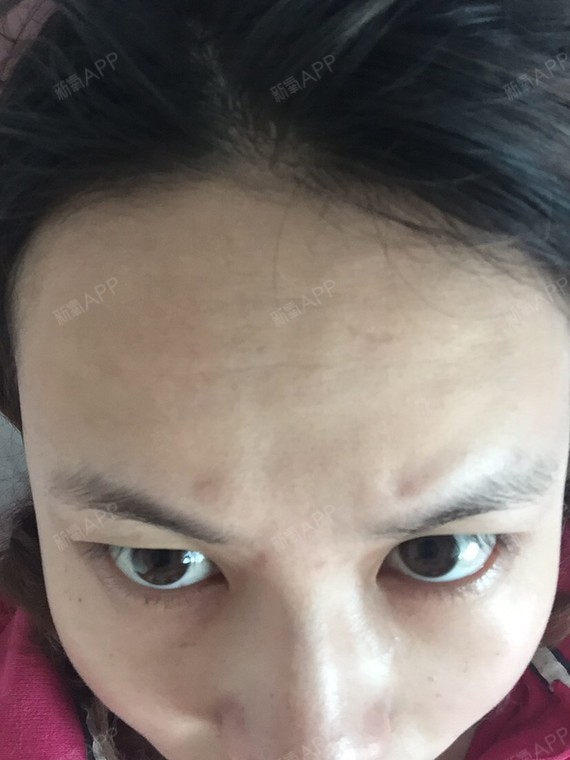 通过新氧消费方案查看自体脂肪丰额头手术轻度疼痛丰额头机构查看长沙