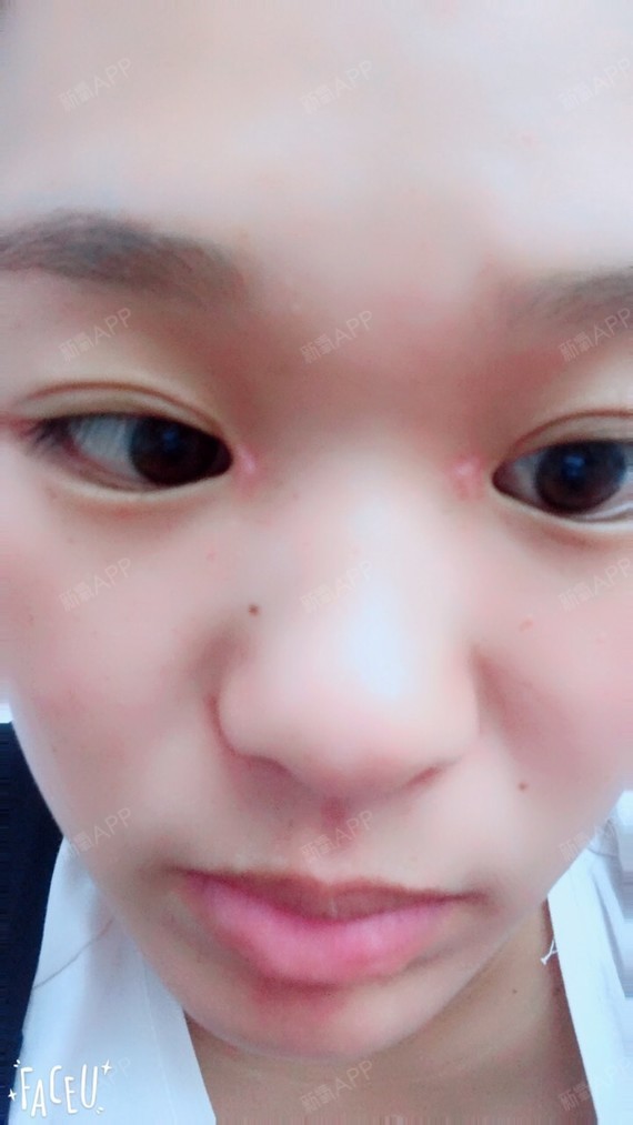 开眼角快三个月了一直红红的有硬块疤痕很明显不知道该_圈子-新氧美容