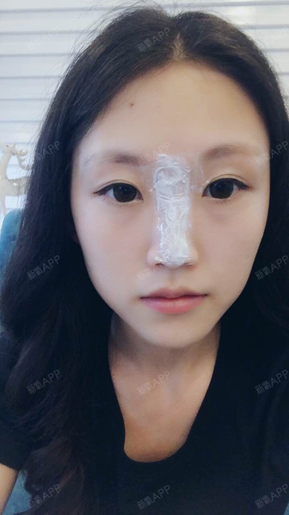 今天终于去做了线雕隆鼻!