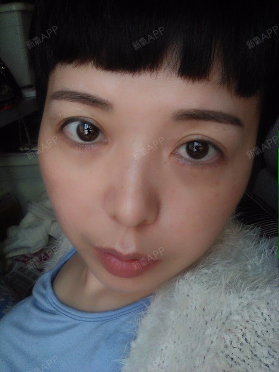 武汉爱美汇外切去眼袋术后第7天