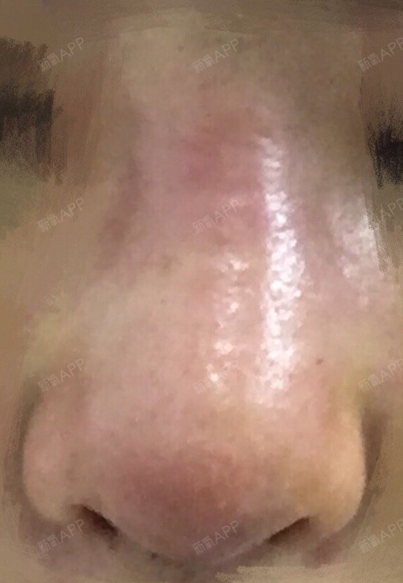 鼻头红去上海复查,撕掉胶布,鼻子又红又肿,用针抽了两管子没有积液