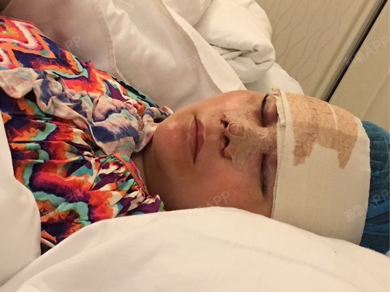 鼻部多项取玻尿酸后额头肿有积液