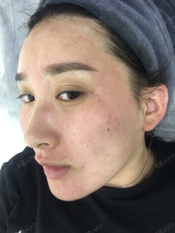 这是我第一天去医院打水光和我没打之前的照片,先上图_圈子-新氧美容