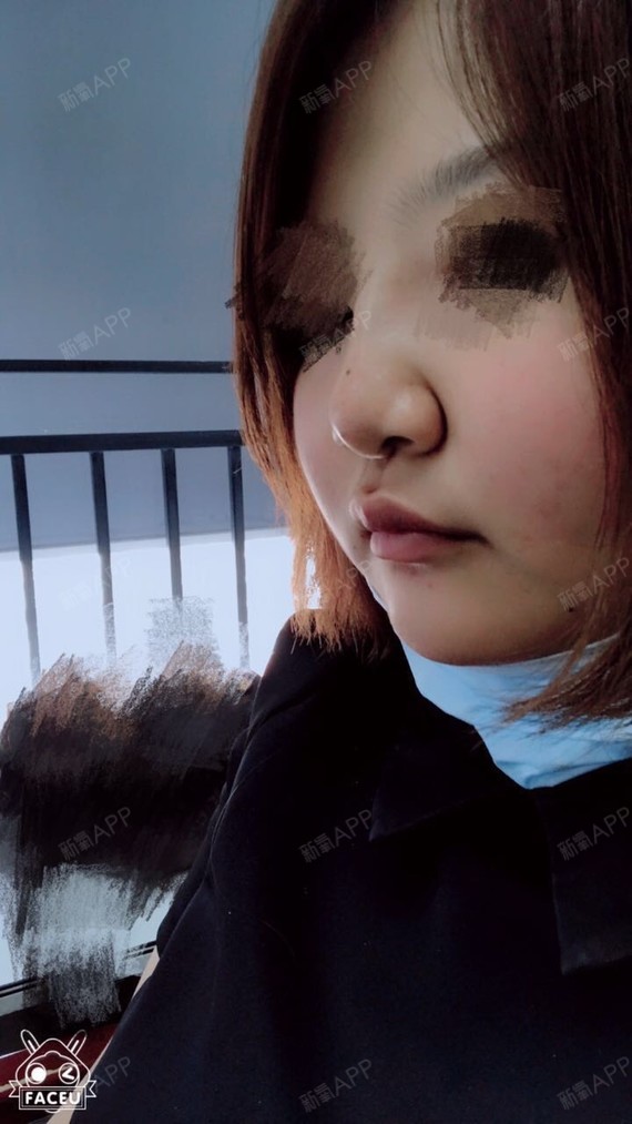 做完线雕第2天鼻子还有点肿希望快点恢复吧