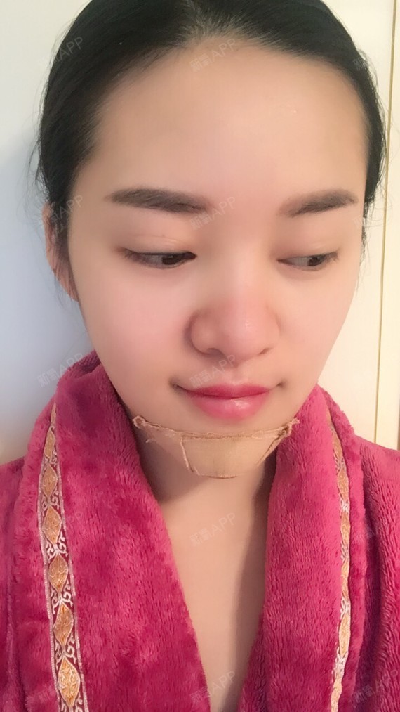q婷婷膨体垫下巴术后第4天美丽日记_新氧整形