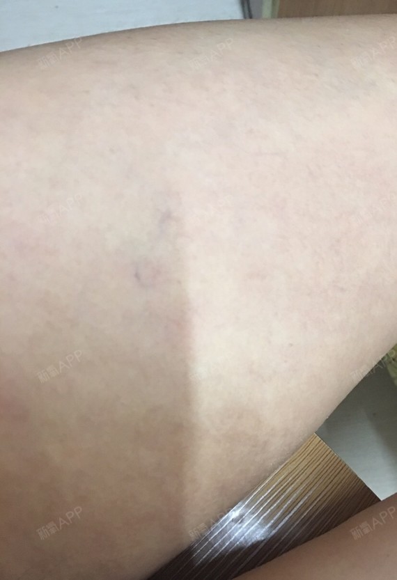 6月14号,一个月了,感觉大腿内侧淤青退了点,但是_圈子-新氧美容整形