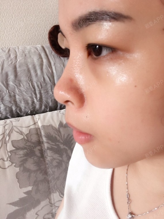 玻尿酸打山根0.5ml够吗?