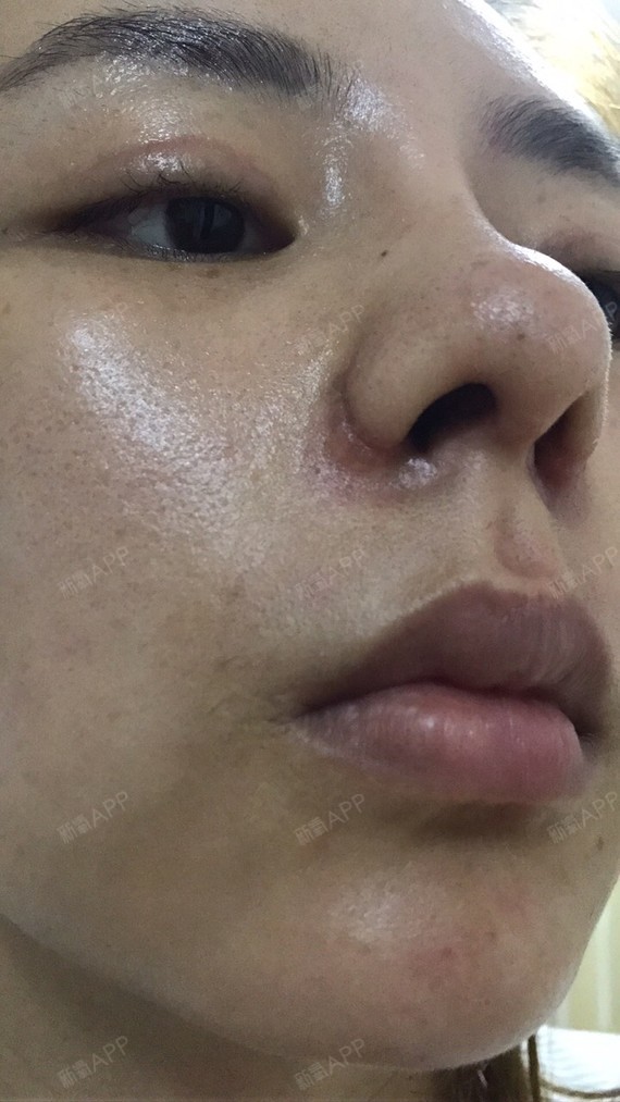 整容失败,鼻子一个月了,鼻翼疤痕疙瘩,鼻翼大小高低_圈子-新氧美容
