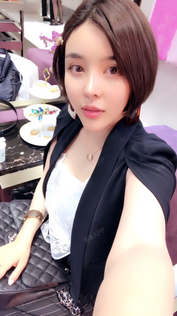切开双眼皮好不好_效果图_大唯子切开双眼皮术后第361天_新氧美容整形