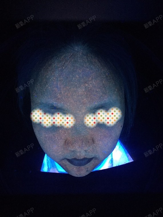 痤疮在伍德灯下的表现,像不像满天星?密集恐惧症慎入!