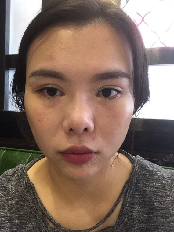 全切双眼皮五年了还是很明显的肉条感 而且感觉眼角开太大了