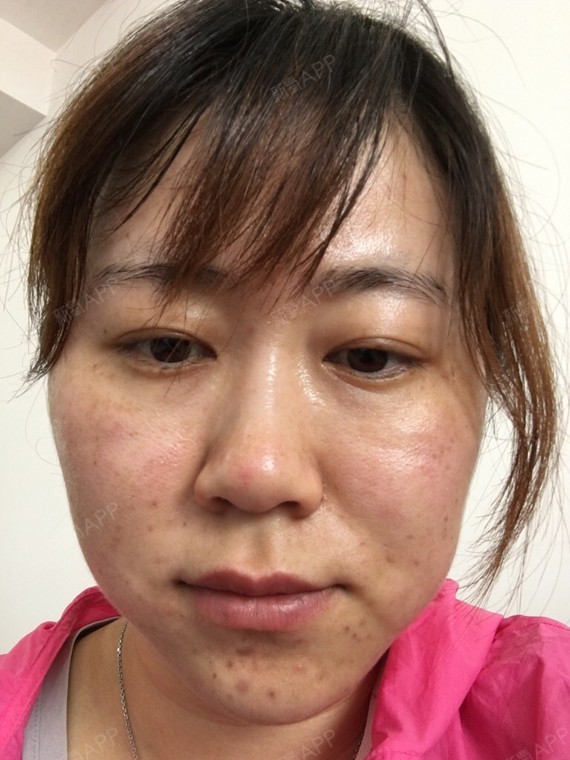 氧气wbv507d水光针术后第139天美丽日记_新氧整形