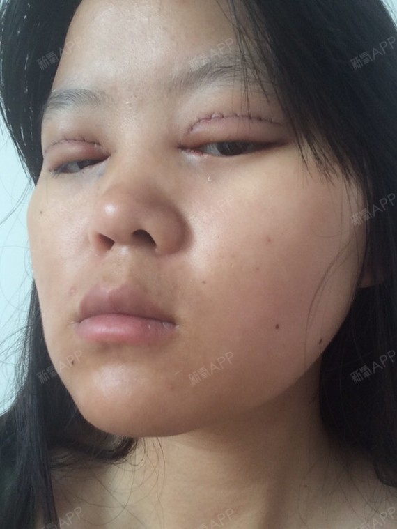 开外眼角好不好_效果图_飞飞猪开外眼角术后第0天_新氧美容整形