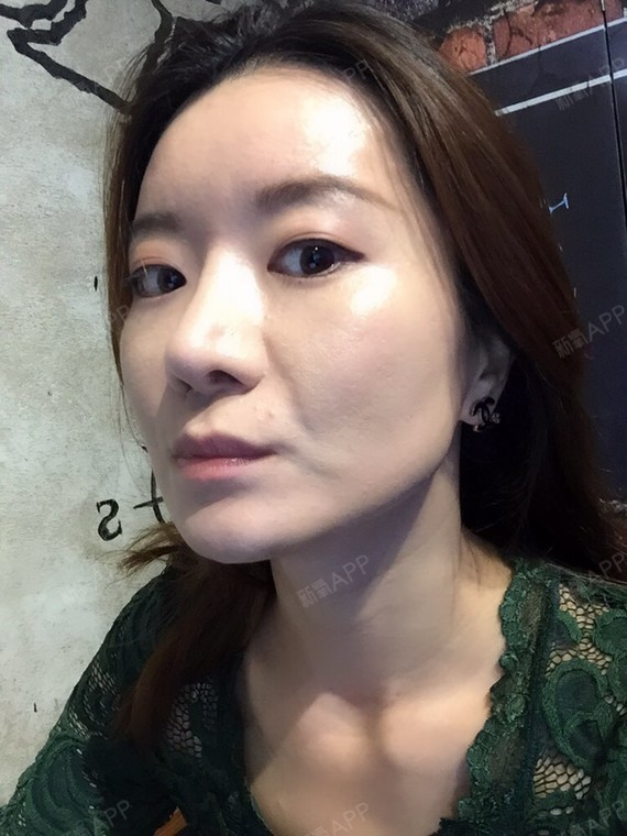 后面追加了瘦脸针 但是到现在也没有出现咬肌无力的感觉 理论上应该4