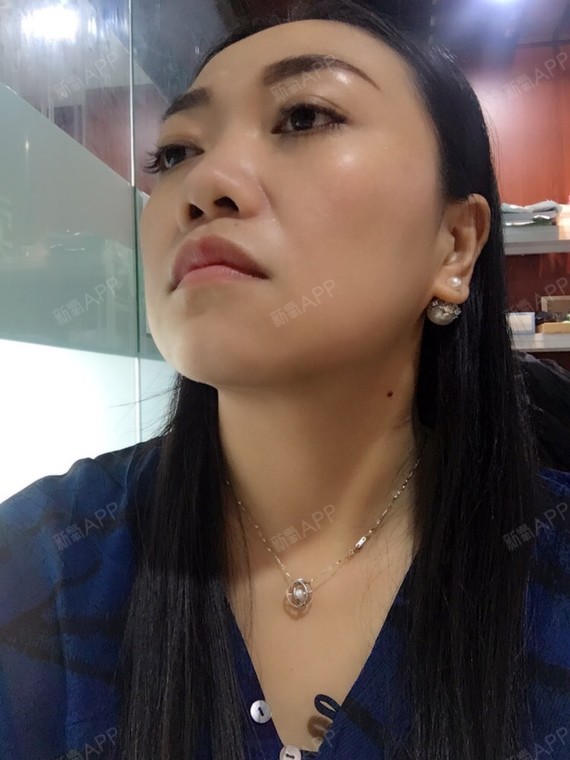 注射瘦脸好不好_效果图_凝大宝宝注射瘦脸术后第10天_新氧美容整形