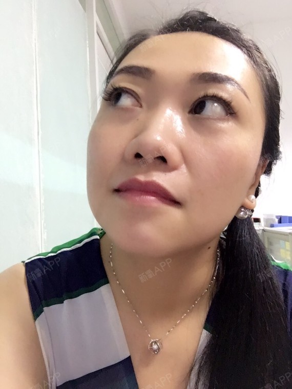 注射瘦脸好不好_效果图_凝大宝宝注射瘦脸术后第10天_新氧美容整形