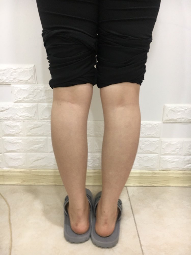 上海慕正医疗美容外科(原上海清杨)肉毒素瘦小腿怎么样?