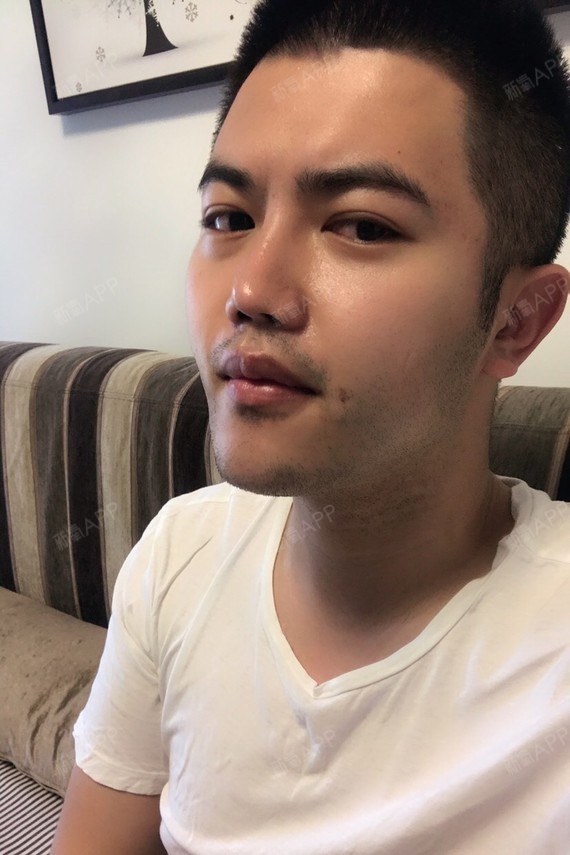 手术已经一个半月了,完全没有任何不良反应和不好的