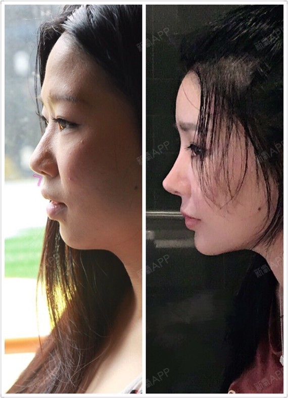 之前来更新了猫手术(鼻小柱基底抬高),贵族手术(鼻_圈子-新氧美容整形