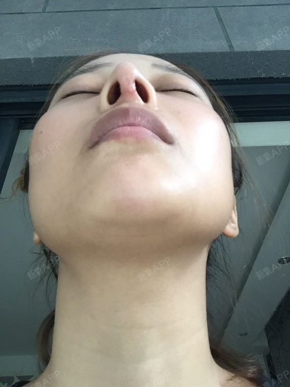鼻子明显是歪的鼻小柱更不用说了鼻小柱差点歪成50°_圈子-新氧美容