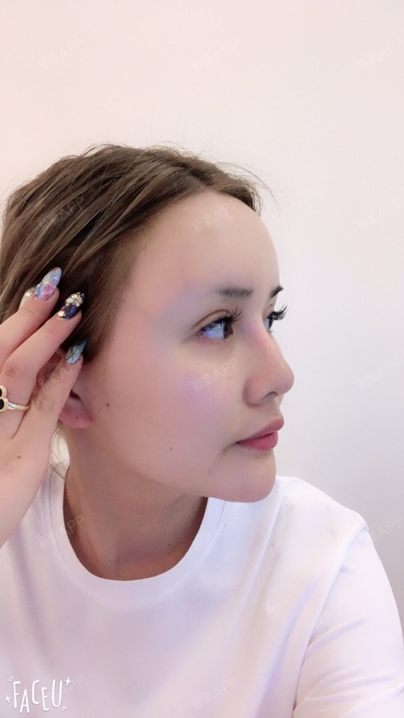 想要欧式鼻杨院长久仰大名所以希望自己能选上了_圈子-新氧美容整形