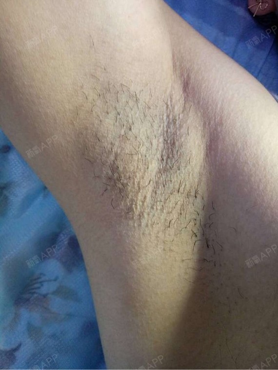 今天去做了腋下腋毛冰点激光脱毛,医生先是了解情况,然后很专业的进行