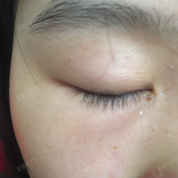 眼皮上有明显的血管.这样可以割双眼皮吗?_圈子-新氧美容整形