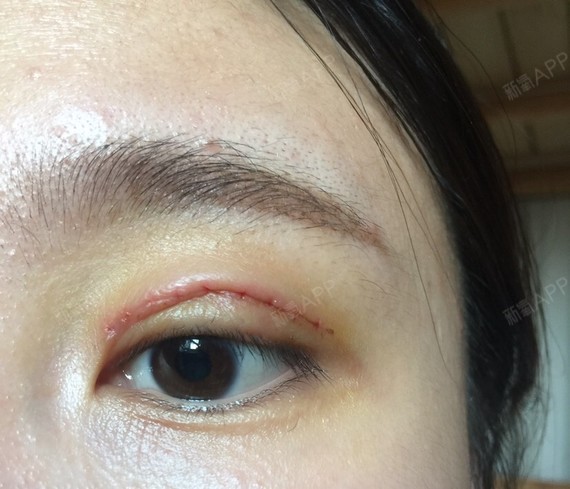 wangjiayu切开双眼皮第3天美丽日记