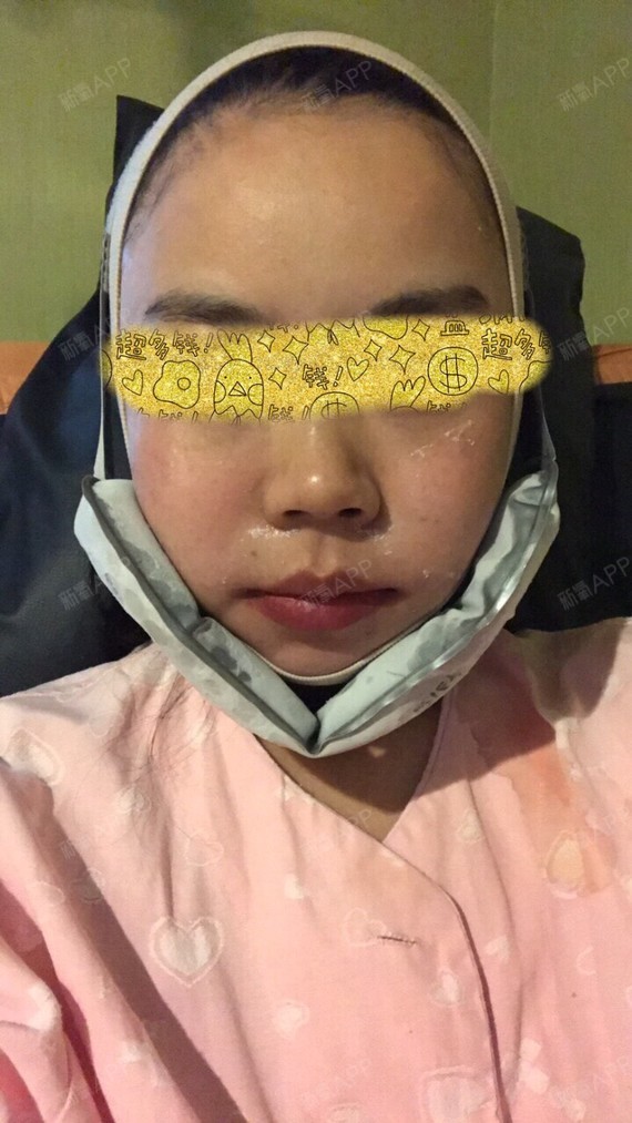 8号晚上8点我就拔管了,拔了管子感觉人轻松了好多,_圈子-新氧美容整形
