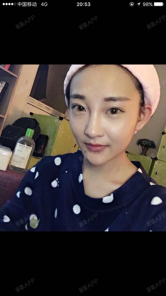 今天是线雕鼻子第三十天了整整一个月现在的鼻子很喜欢因为不痛不肿