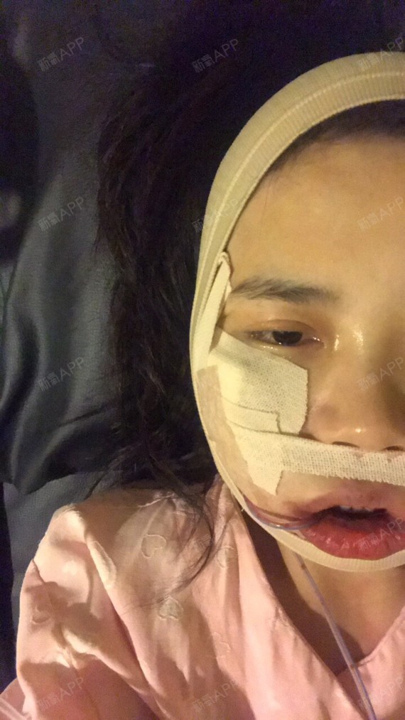 江南小猪宝颧弓降低第1天美丽日记