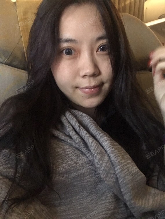 新氧- 江南小猪宝 | 面部轮廓 | 颧骨颧弓 | 瘦脸 | v型脸 | 面部吸脂