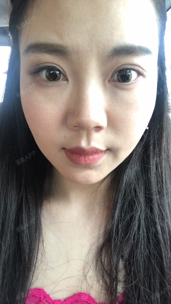 颧弓降低好不好_效果图_江南小猪宝颧弓降低术后第2天_新氧美容整形