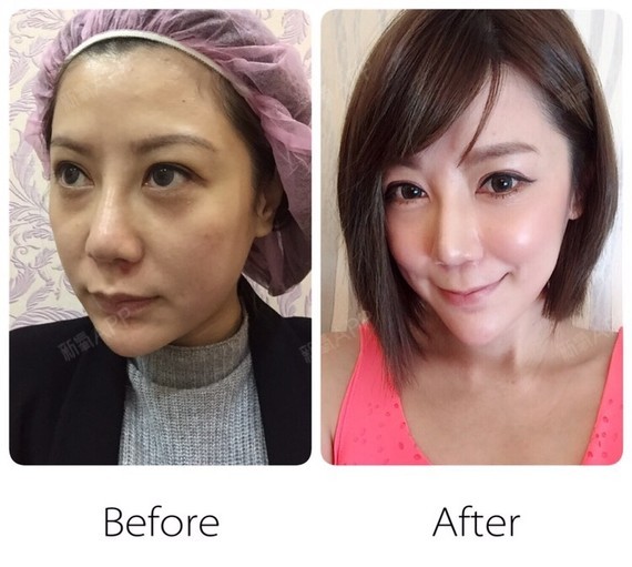 高雄拉皮手术提升好不好_效果图_潘妮儿拉皮手术提升术后第50天_新氧