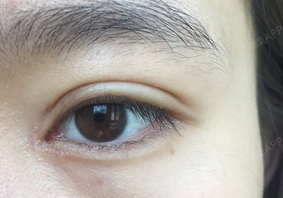 眼角好像增生更加严重了