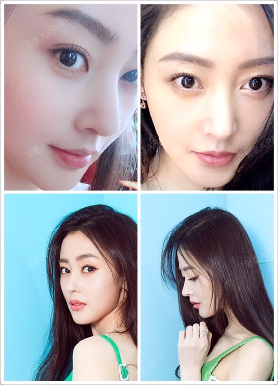 [:13][:13][:13]今天是我做轮廓手术的_圈子-新氧美容整形