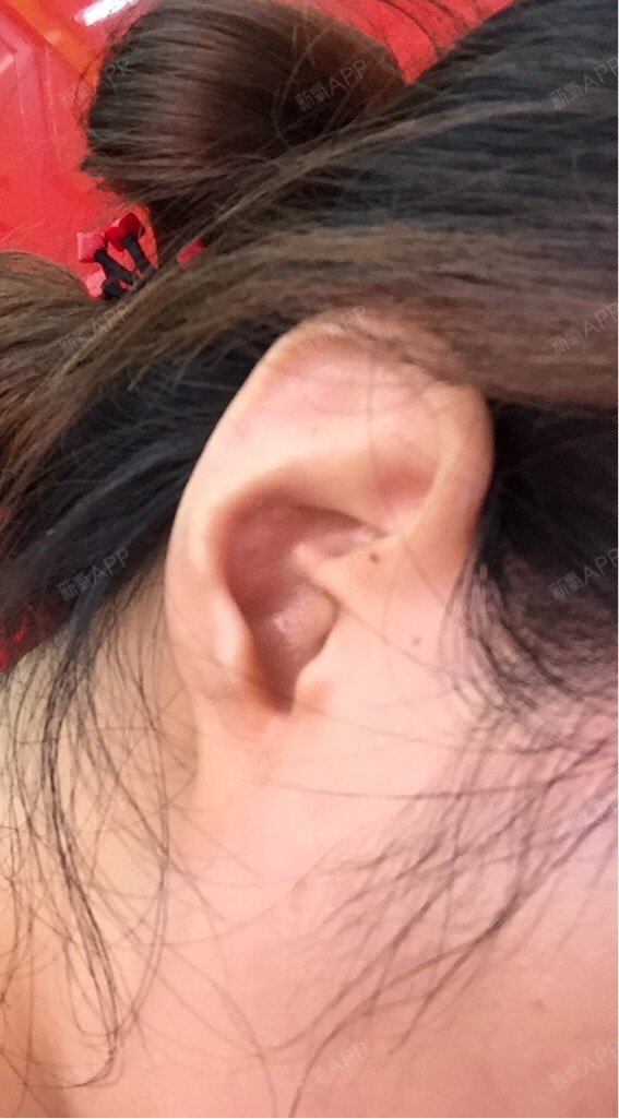 取耳软骨垫鼻尖后三个月了耳蜗红正常吗取耳软骨的耳朵