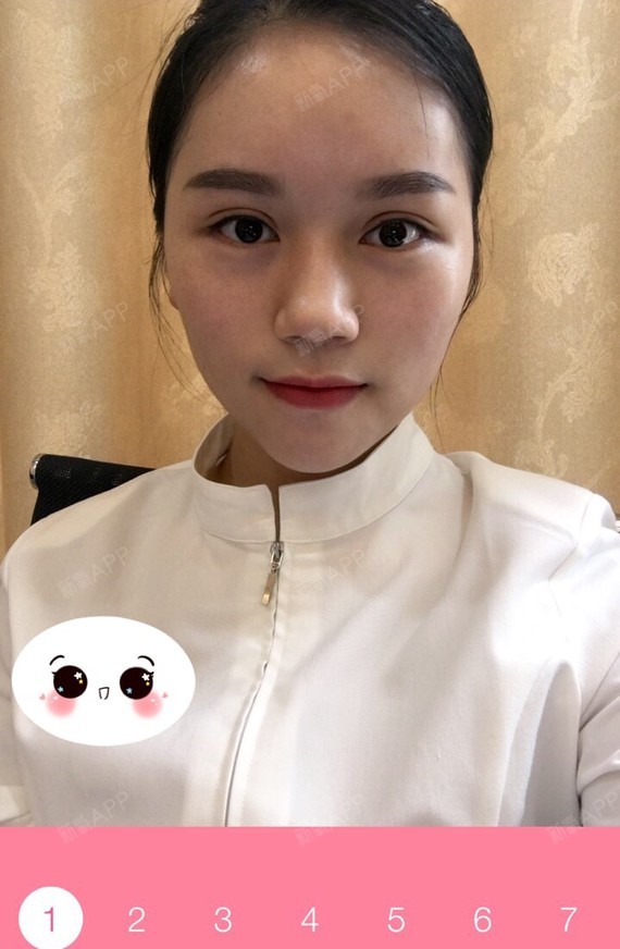 瘦脸针第十一天