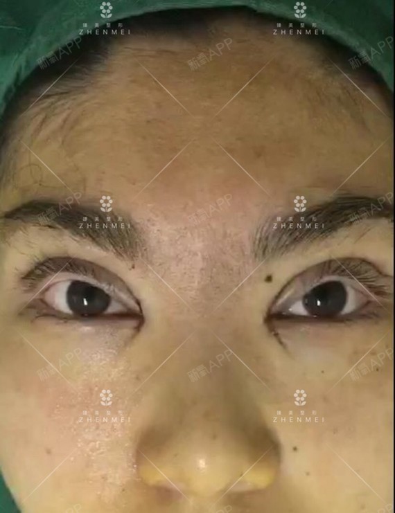 案例分享:上睑提肌缩短,双眼皮,开眼角#随着人年_圈子-新氧美容整形