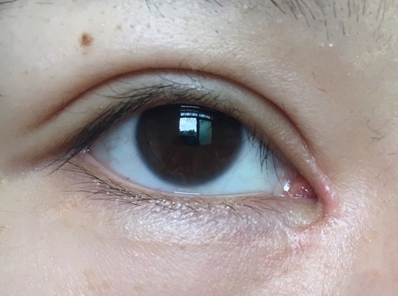 开内眼角好不好_效果图_氧气3ia3b5e开内眼角术后第123天_新氧美容